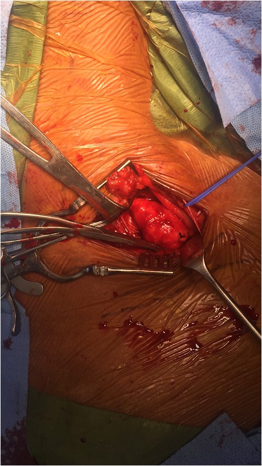 Anterior scalenectomy with poststenotic aneurysmal changes of the subclavian artery.