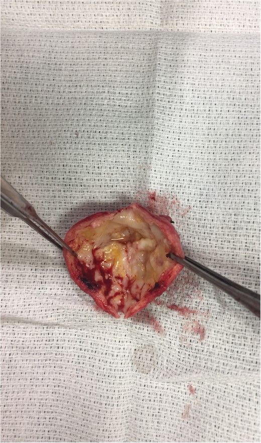 Resected portion of aneurysm inspected for mural thrombus.