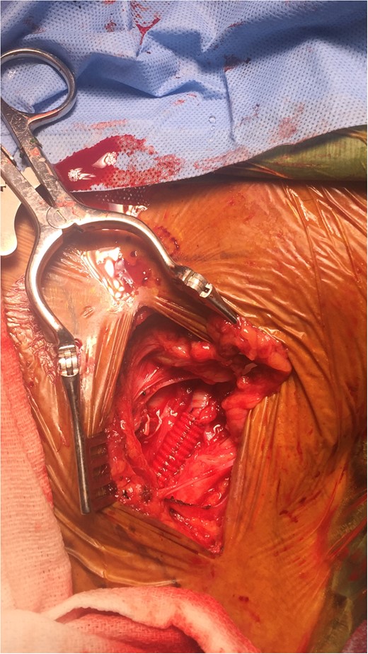 Reconstruction of subclavian artery with Dacron graft.