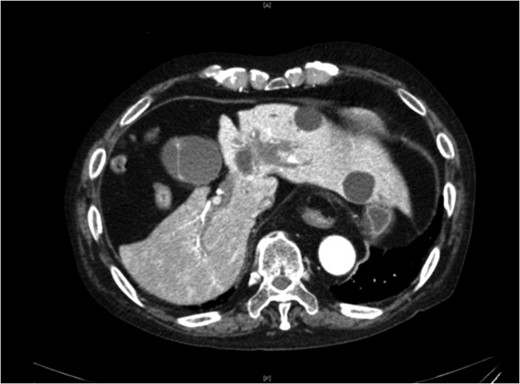 Abdominal contrast-enhanced CT. Abdominal contrast-enhanced CT revealed extravasation of contrast medium in the gallbladder.