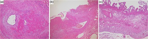 Histopathological findings. (a) At the area of the gallbladder with bleeding, infiltrations of inflammatory cells around the blood vessels was seen in the muscularis propria. (b) Vascular rupture was seen in the muscularis propria. (c) Little inflammatory cell infiltration was observed in the areas of the gallbladder without bleeding.
