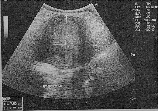 Ultrasonography of the scrotum showing a heterogeneous mass within the right scrotal sac.