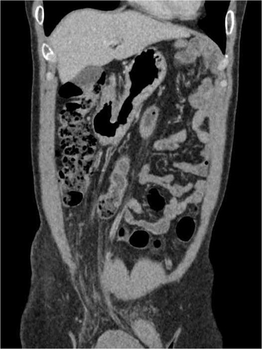 Coronal view of the thorax and abdomen CT scan showing a right inguinal hernia containing greater omentum.
