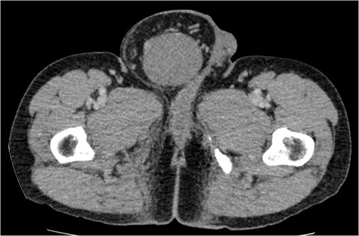 Cross-sectional view of the lower abdomen CT scan revealed a right inguinal hernia containing the greater omentum and a heterogeneous mass.