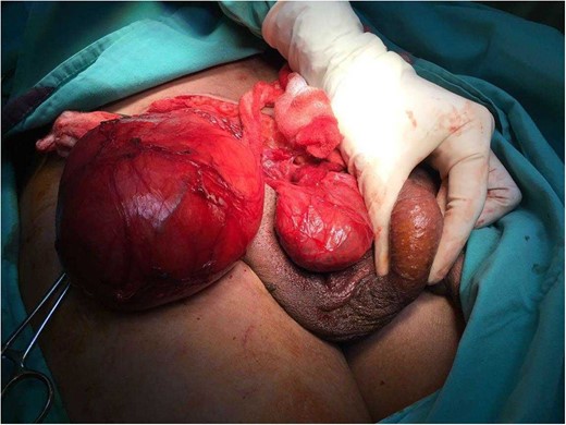 Picture of the omental mass within the hernia sac (left), right testicle (middle) and left testicle in the scrotal sac.