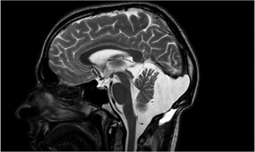 Sagittal T2 weighted image showing a marsupialized retrovermian arachnoid cyst.