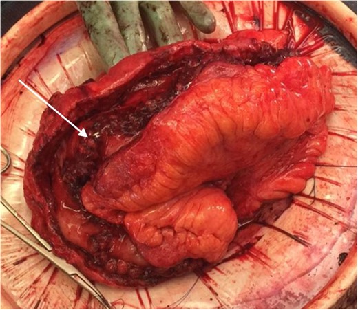 Completed posterior wall of the Michelassi stricturoplasty showing internal suture line (arrow).