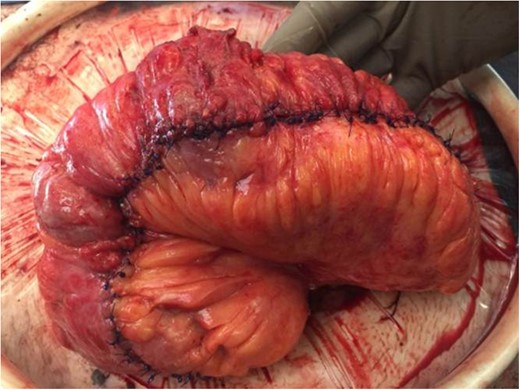 Completed Michelassi stricturoplasty for the 100 cm of diseased bowel.