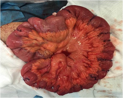 Small bowel with 12 Heineke-Mikulicz stricturoplasties.