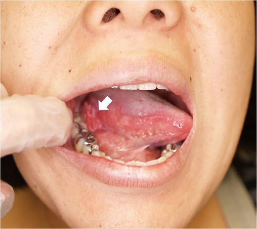 A 33-year-old pregnant woman presented with a carcinoma on her tongue. White arrow indicates the tumour.