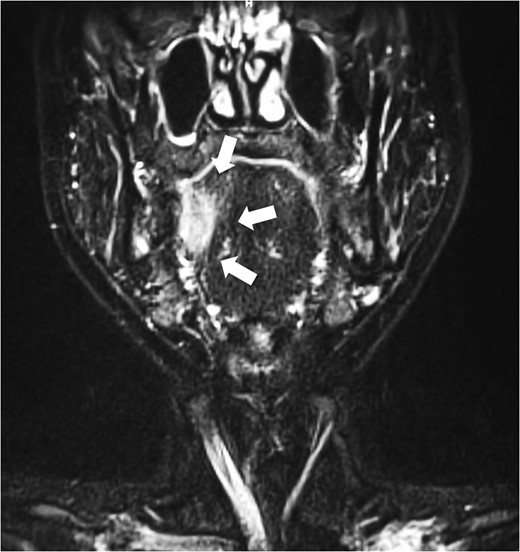 Pre-operative coronal MRI. Invasion into tongue muscle was observed. White arrow indicates the tumour.