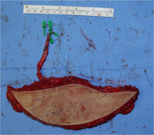 A free antero-lateral thigh flap was harvested from her right thigh.