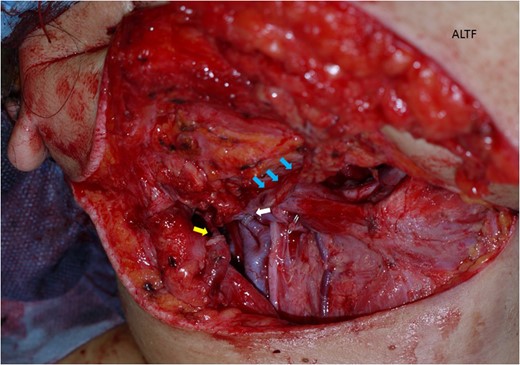 The antero-lateral thigh flap (ALTF) was transferred to her neck area. The descending branch of lateral circumflex femoral artery (blue arrows indicating) was anastomosed her right facial artery. A comitant vein was anastomosed to her external jugular vein in end-to-end fashion with a 2.5 mm microvascular anastomotic device (yellow arrow). The other comitant vein was anastomosed in the same way to a branch of internal jugular vein (white arrow).