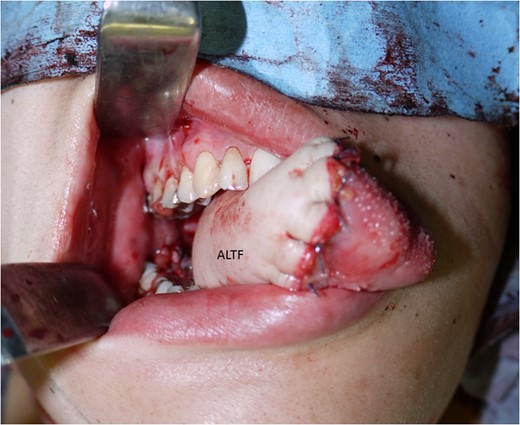 The antero-lateral thigh flap (ALTF) was pulled through, trimmed and sutured to fill the tongue defect.