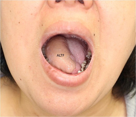 Two years after the operation, opening her mouth.