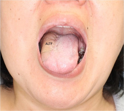 Two years after the operation, sticking out her tongue. She faces no difficulty in speaking, mastication and swallowing.