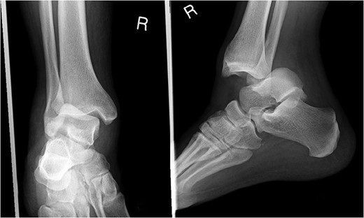 Plain film X-rays of right ankle showing total posterior dislocation of the ankle joint with no fracture of the medial or lateral malleolus.