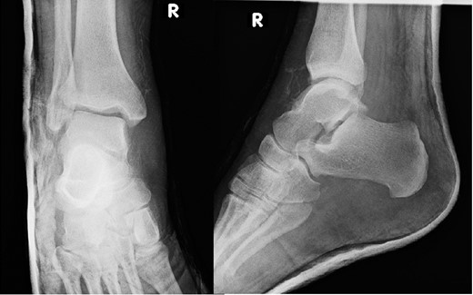 Post reduction films showing adequate reduction of the ankle joint with no talar shift or syndesmotic injury.