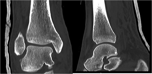 Post reduction CT scan showing congruent reduction of the dislocation without associated fractures.