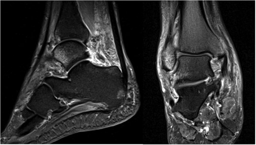 T2 MRI images showing high signal in medial malleolus, lateral malleolus and talus signifying bone bruise.
