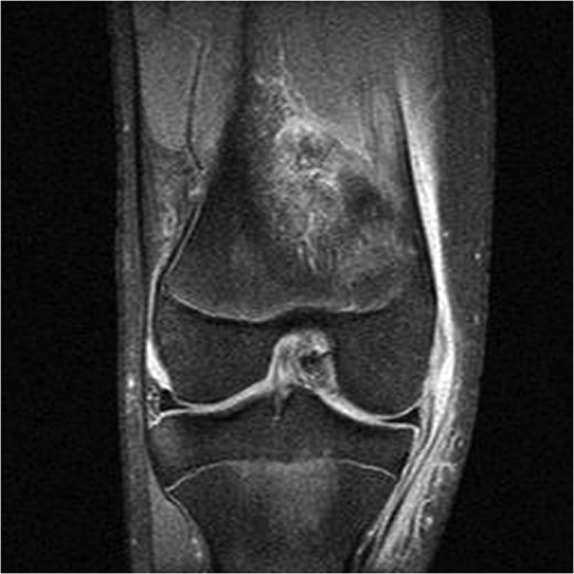 MRI demonstrating MCL injury.