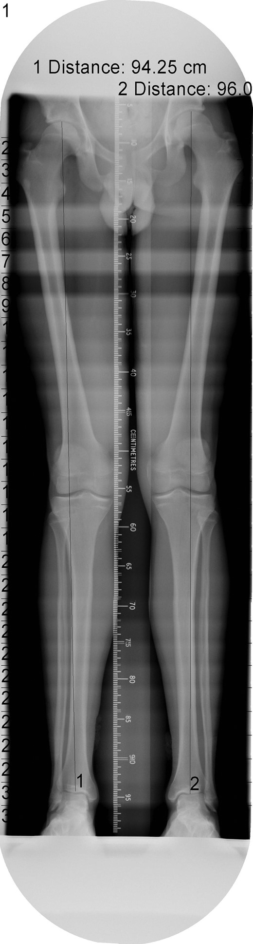 Long-leg alignment radiograph showing valgus deformity of the right knee.