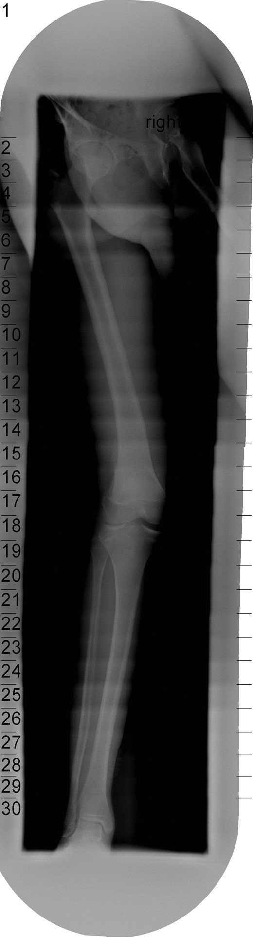 Radiograph demonstrating opening of the medial compartment and increased valgus alignment on single-limb weight bearing.