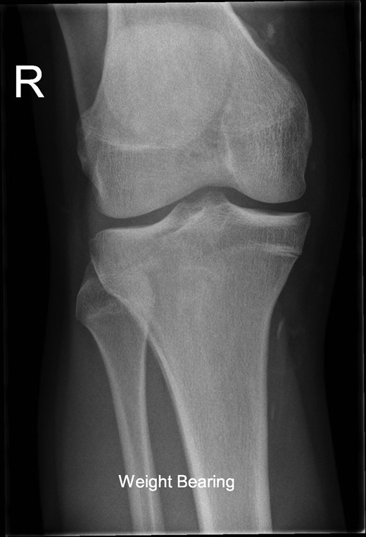 Weight-bearing AP radiograph of knee.