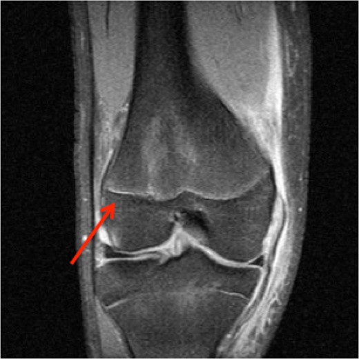 MRI showing increased fluid density around the lateral distal femoral physis (red arrow).