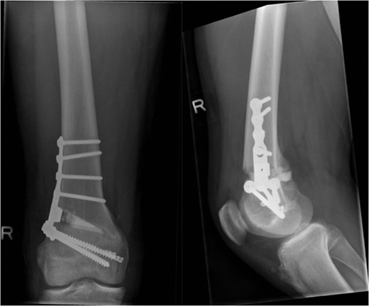 AP and lateral post-operative radiographs.