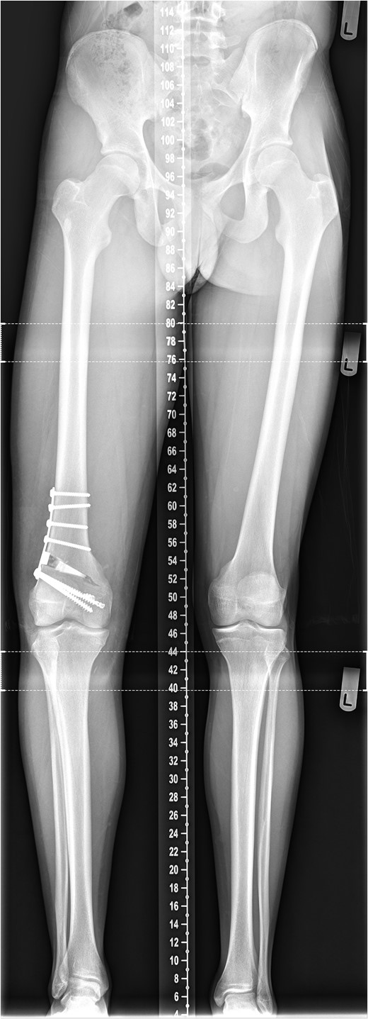 Post-operative long-leg alignment radiograph.