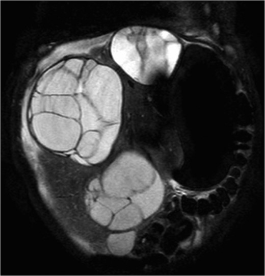 Coronal T2 abdominal MRI demonstrating multiple, large, multi-loculated cystic hepatic masses and significant hepatomegaly.