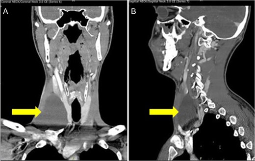 CT scan of the neck shows an ovoid cystic appearing lesion present at the base of the right neck (A: Coronal view and B: sagittal view).