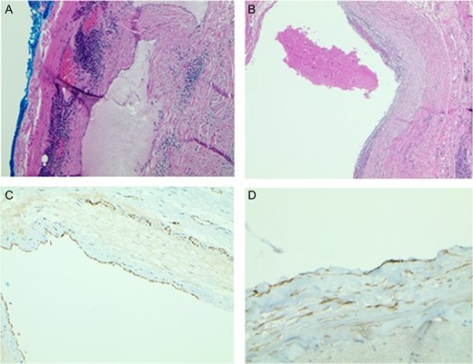 (A) Light Microscopy view of cyst wall with lymphoid aggregates (×20). (B) Blood in the dilated lymphovascular space (×40). (C) CD31 highlights the lining of endothelial cells (×40). (D) D2-40 positive stain highlights the lining of endothelial cells (×100).