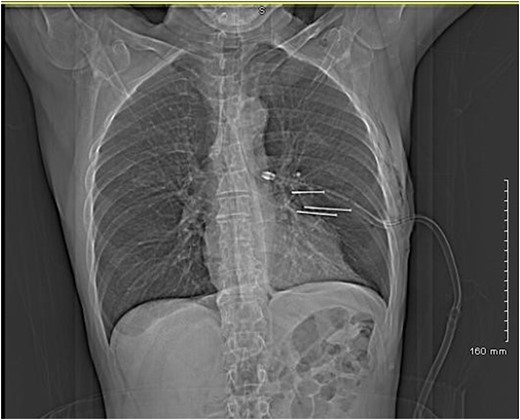 CT thorax showing the three nails on coronal view.