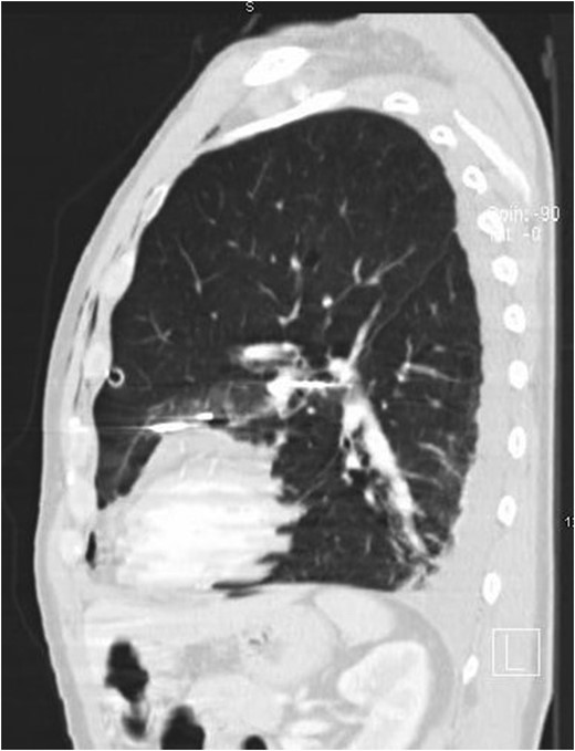 CT thorax showing the three nails on sagittal view.