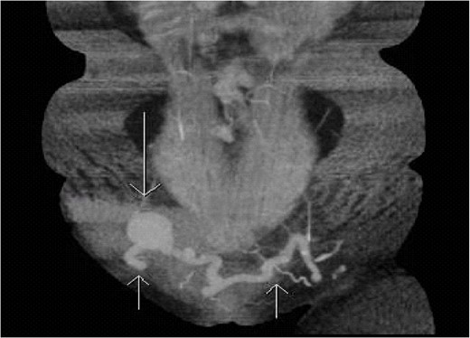 Coronal section of CTA of the abdomen/pelvis capturing the anomalous connection between the left and right greater saphenous veins with an aneurysm near the right saphenofemoral junction. Short arrows pointing up shows the tortuous connection of the greater saphenous veins. Long arrow pointing down demonstrates an aneurysm in the anomalous saphenous vein connection.