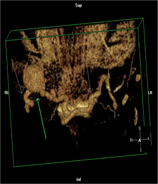 3D reconstruction of CTA of the abdomen/pelvis. Green arrow pointing up demonstrates an aneurysm in the anomalous saphenous vein connection. White arrows pointing down shows the tortuous connection of the greater saphenous veins.