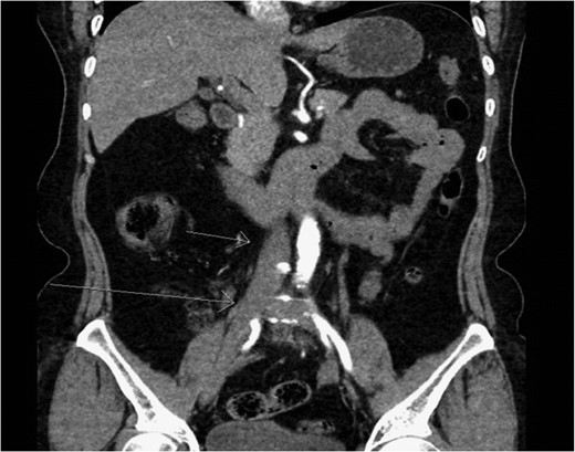 CTA of Abdomen/pelvis showing left iliac vein atresia. Short arrow is pointing to the inferior vena cava and long arrow is pointing to the right iliac vein. The left iliac vein is absent.