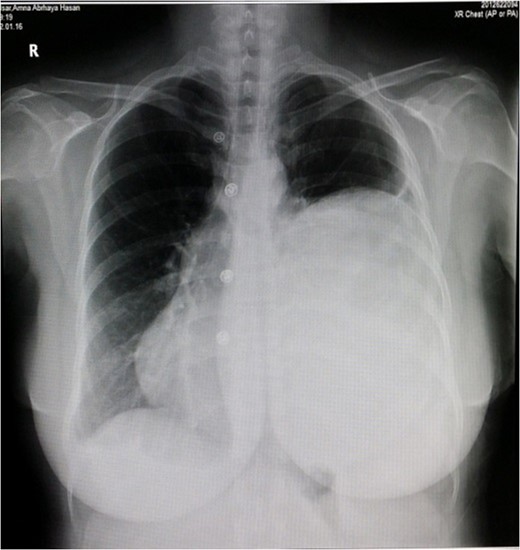 X-ray of the chest.