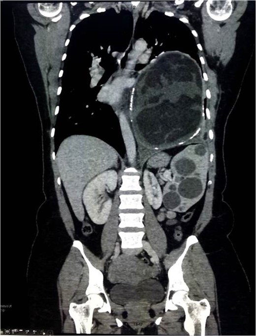Coronal view of CT scan of the chest/abdomen/pelvis.