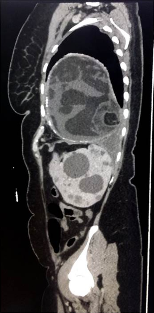 Sagittal view of CT scan of the chest/abdomen/pelvis.