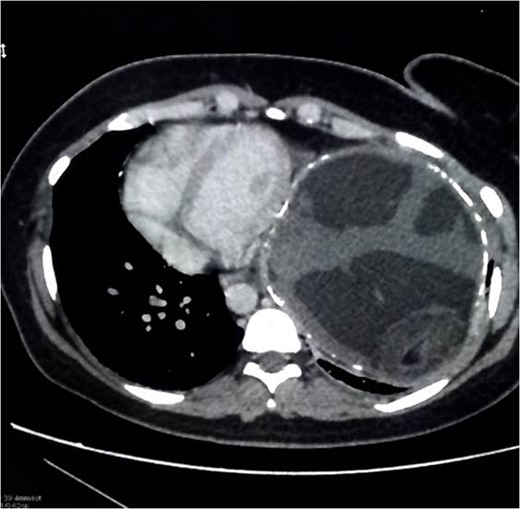 Axial view of CT scan of the chest/abdomen/pelvis.