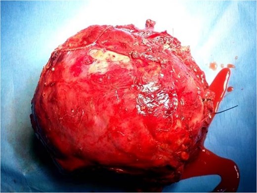 Teratoma sac after aspiration and removal from the thorax with noted hair particles.