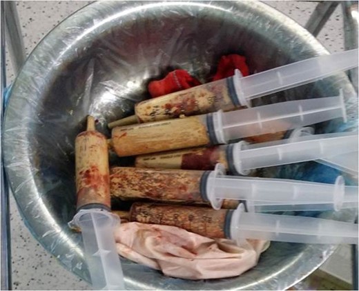 Aspirated fluid from the teratoma sac.