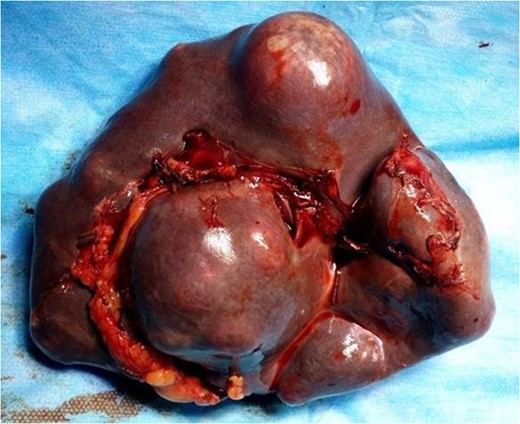 Visceral surface of the spleen with noted multiple masses.