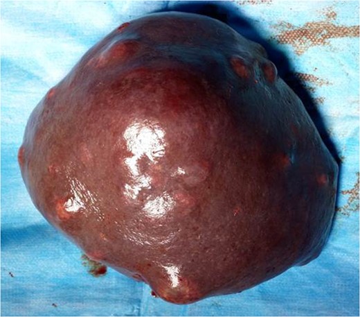 Diaphragmatic surface of the spleen with multiple masses.
