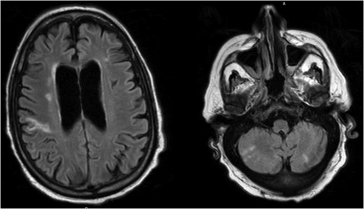 Brain MRI demonstrating multiple bilateral areas of restricted diffusion consistent with ischemic stroke.