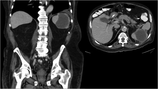 Abdominal CT scan demonstrating an 8.1 cm splenic lesion consistent with splenic abscess.