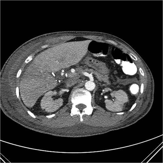 Axial CT image with clip artifact surrounding the location of the bile duct.